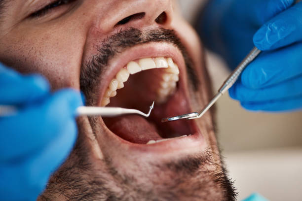 Best Emergency Dentist for Lost Fillings or Crowns in Dland, MI