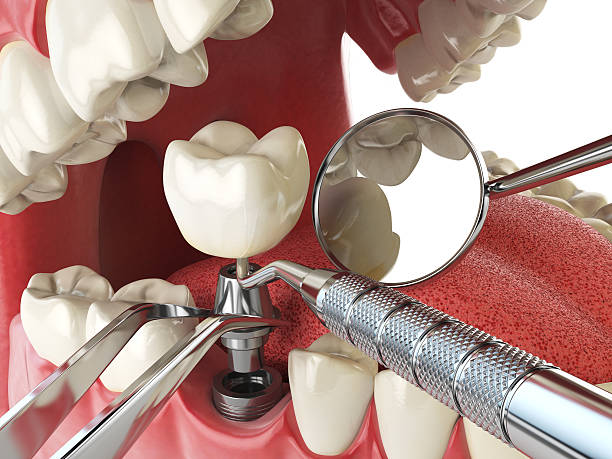 Best Emergency Dental Care for Abscessed Tooth in Dland, MI